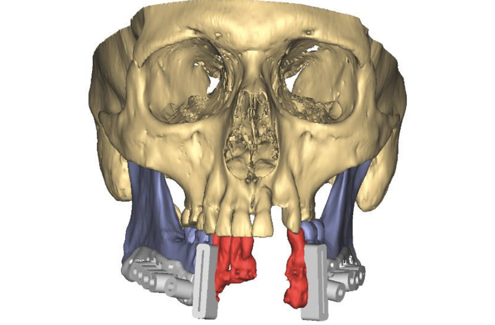VSP for Patient-Specific Reconstructive Microsurgery Case Study Figure 3b